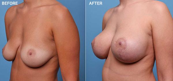 Breast Lift result at Nebraska Medicine Village Pointe Aesthetic Surgery | Dreams MedSpa in Omaha, NE