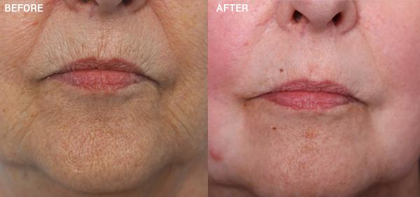Chemical Peel result at Nebraska Medicine Village Pointe Aesthetic Surgery | Dreams MedSpa in Omaha, NE