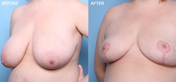 Breast Reduction result at Nebraska Medicine Village Pointe Aesthetic Surgery | Dreams MedSpa in Omaha, NE