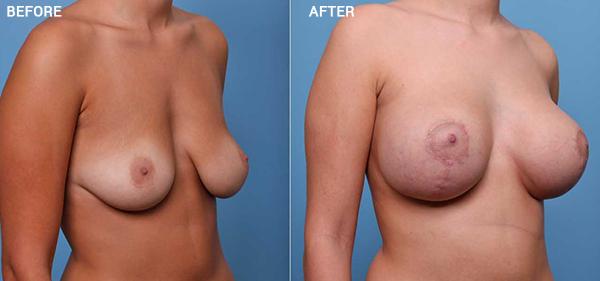 Breast Lift result at Nebraska Medicine Village Pointe Aesthetic Surgery | Dreams MedSpa in Omaha, NE
