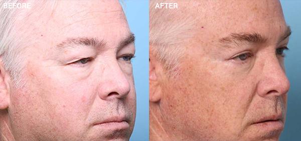 Blepharoplasty result at Nebraska Medicine Village Pointe Aesthetic Surgery | Dreams MedSpa in Omaha, NE