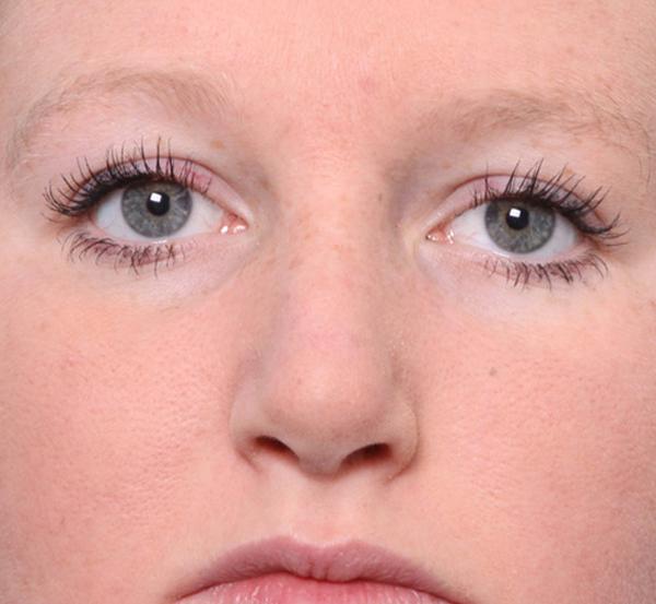 Nebraska Medicine Village Pointe Aesthetic Surgery | Dreams MedSpa after — Omaha, NE
