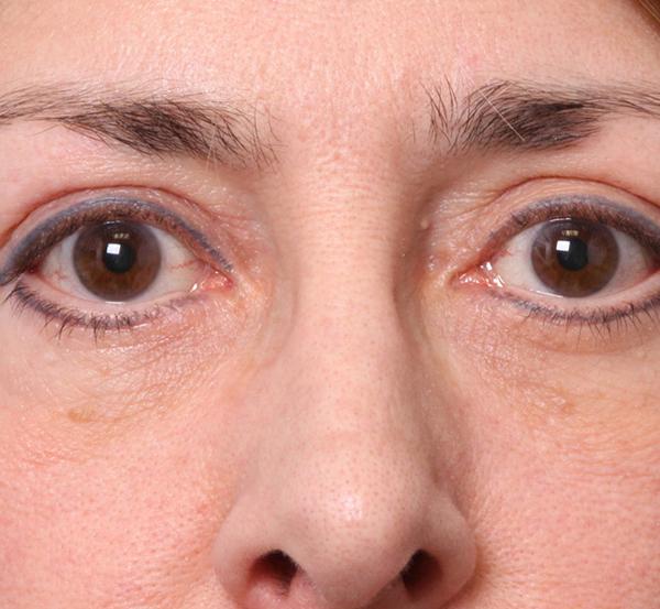 Nebraska Medicine Village Pointe Aesthetic Surgery | Dreams MedSpa after — Omaha, NE