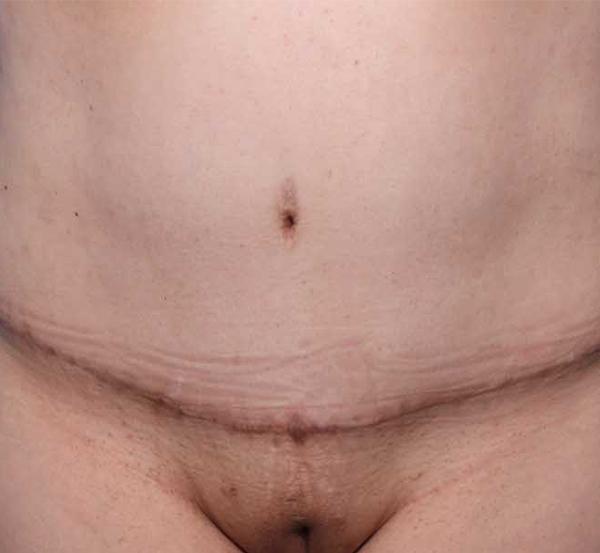 Tummy Tuck after at Nebraska Medicine Village Pointe Aesthetic Surgery | Dreams MedSpa in Omaha, NE