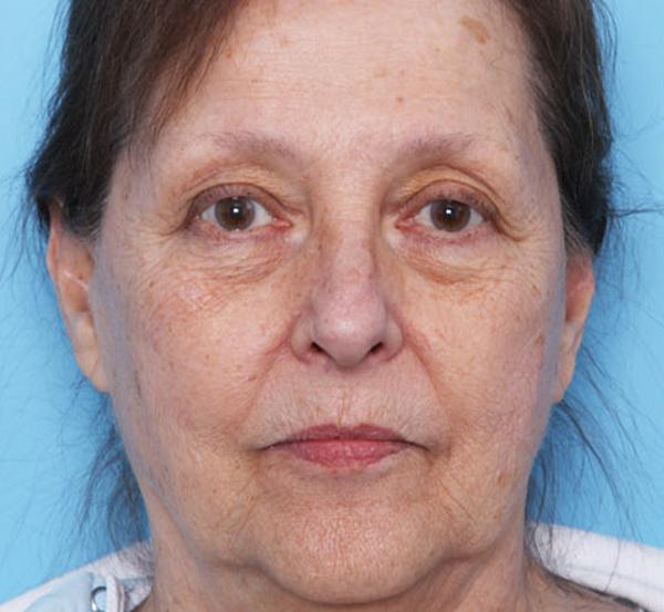 Chemical Peel before at Nebraska Medicine Village Pointe Aesthetic Surgery | Dreams MedSpa in Omaha, NE
