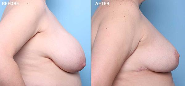 Breast Reduction result at Nebraska Medicine Village Pointe Aesthetic Surgery | Dreams MedSpa in Omaha, NE