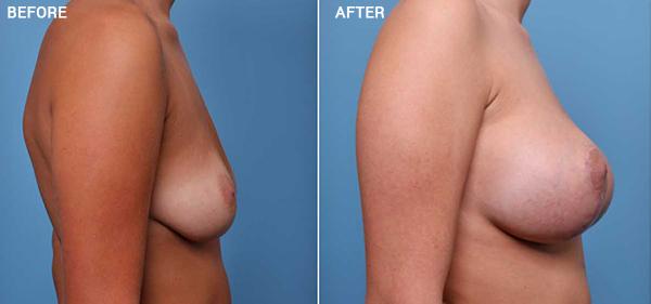 Breast Lift result at Nebraska Medicine Village Pointe Aesthetic Surgery | Dreams MedSpa in Omaha, NE