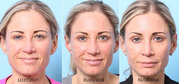 Chemical Peel result at Nebraska Medicine Village Pointe Aesthetic Surgery | Dreams MedSpa in Omaha, NE
