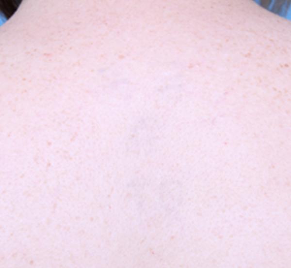 Nebraska Medicine Village Pointe Aesthetic Surgery | Dreams MedSpa after — Omaha, NE
