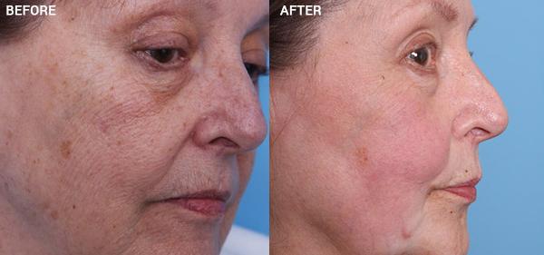 Chemical Peel result at Nebraska Medicine Village Pointe Aesthetic Surgery | Dreams MedSpa in Omaha, NE