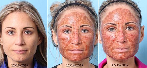 Chemical Peel result at Nebraska Medicine Village Pointe Aesthetic Surgery | Dreams MedSpa in Omaha, NE