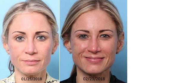 Chemical Peel result at Nebraska Medicine Village Pointe Aesthetic Surgery | Dreams MedSpa in Omaha, NE