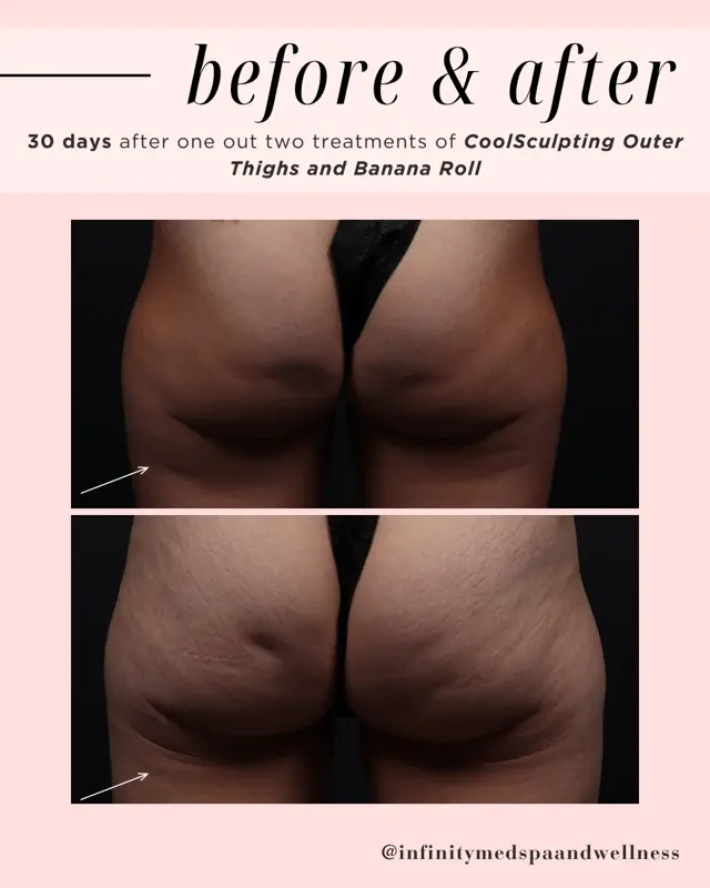 CoolSculpting before at Infinity MedSpa and Wellness in Charlotte, NC