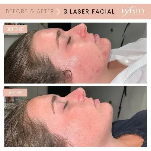Laser Skin Resurfacing result at Infinity MedSpa and Wellness in Charlotte, NC