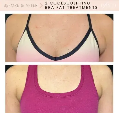 CoolSculpting result at Infinity MedSpa and Wellness in Charlotte, NC
