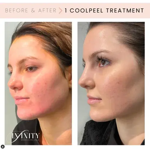 Laser Skin Resurfacing result at Infinity MedSpa and Wellness in Charlotte, NC