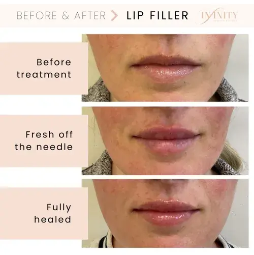 Lip Filler result at Infinity MedSpa and Wellness in Charlotte, NC