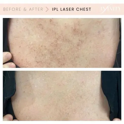 Laser Skin Resurfacing result at Infinity MedSpa and Wellness in Charlotte, NC