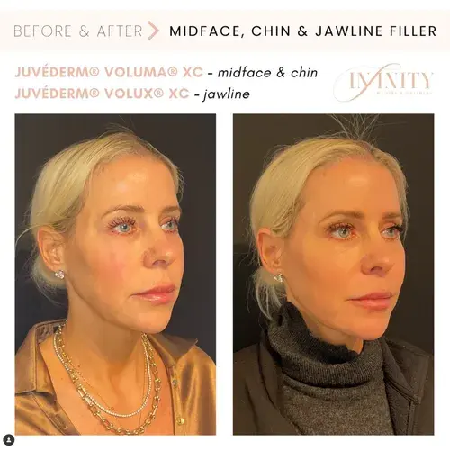 Dermal Fillers result at Infinity MedSpa and Wellness in Charlotte, NC