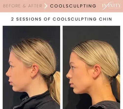 CoolSculpting result at Infinity MedSpa and Wellness in Charlotte, NC