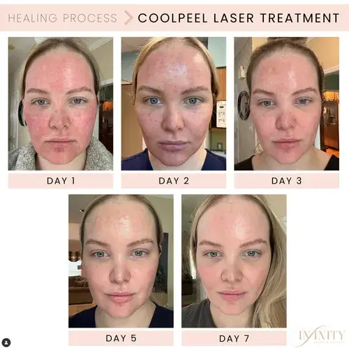 Infinity MedSpa and Wellness laser treatment result — Charlotte, NC