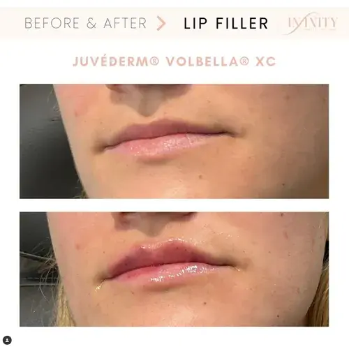Lip Filler result at Infinity MedSpa and Wellness in Charlotte, NC