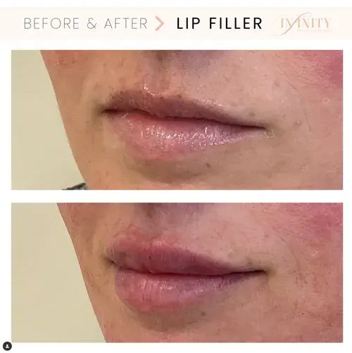 Lip Filler result at Infinity MedSpa and Wellness in Charlotte, NC
