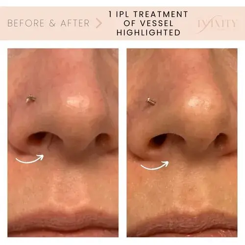 Laser Skin Resurfacing result at Infinity MedSpa and Wellness in Charlotte, NC