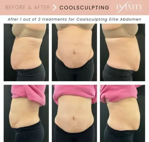 CoolSculpting result at Infinity MedSpa and Wellness in Charlotte, NC