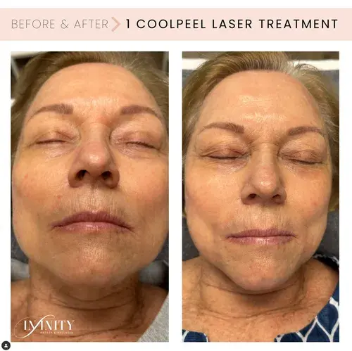 Infinity MedSpa and Wellness laser treatment result — Charlotte, NC