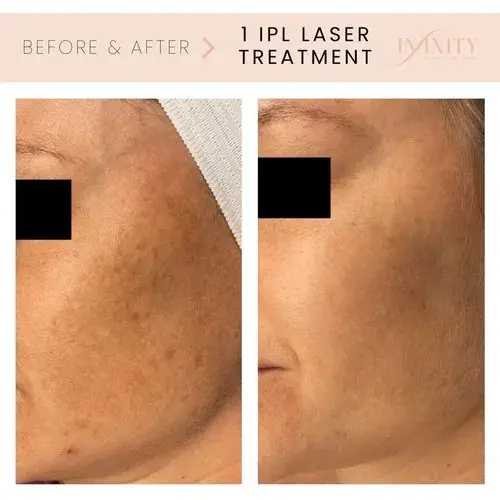 Laser Skin Resurfacing result at Infinity MedSpa and Wellness in Charlotte, NC