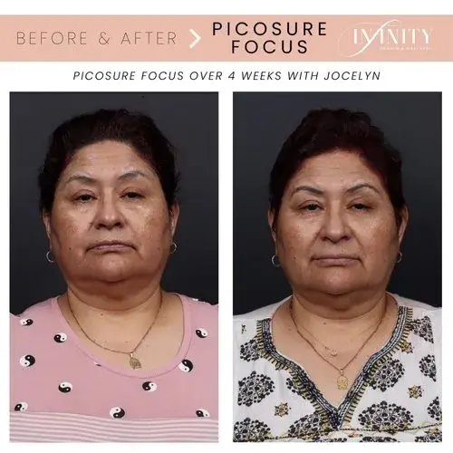 Laser Skin Resurfacing result at Infinity MedSpa and Wellness in Charlotte, NC