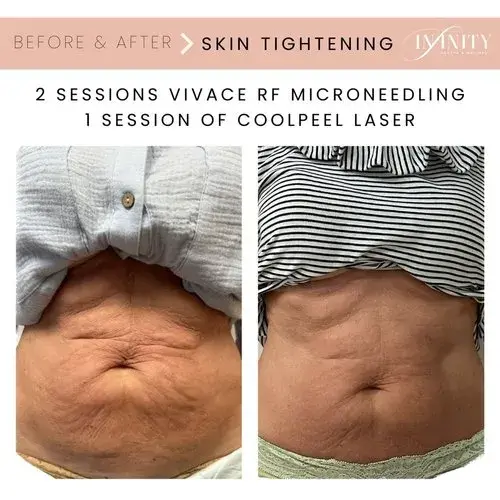 Laser Skin Resurfacing result at Infinity MedSpa and Wellness in Charlotte, NC
