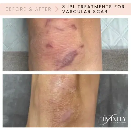 Infinity MedSpa and Wellness laser treatment result — Charlotte, NC
