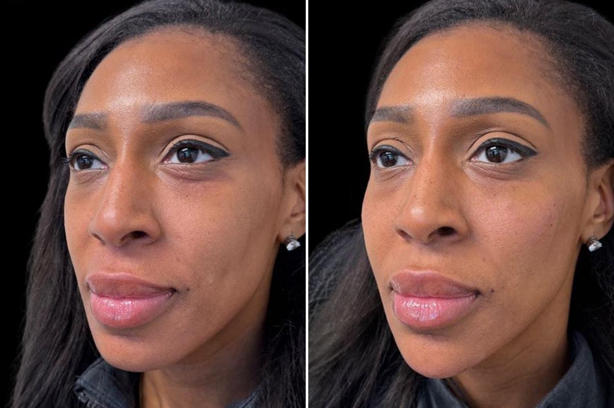 Becker Aesthetics & Plastic Surgery cheek filler result — Philadelphia, PA
