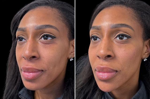 Dermal Fillers result at Becker Aesthetics & Plastic Surgery in Philadelphia, PA
