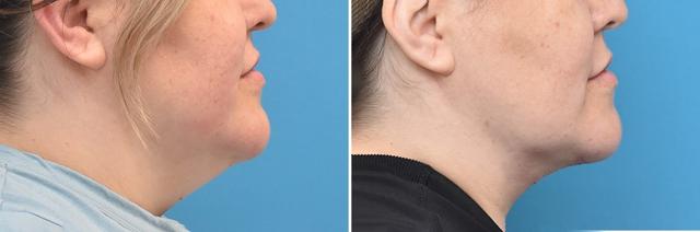 Neck Lift result at Becker Aesthetics & Plastic Surgery in Philadelphia, PA