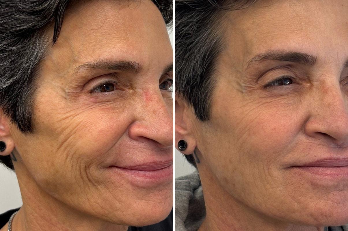 Becker Aesthetics & Plastic Surgery cheek filler result — Philadelphia, PA