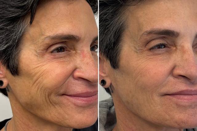 Dermal Fillers result at Becker Aesthetics & Plastic Surgery in Philadelphia, PA