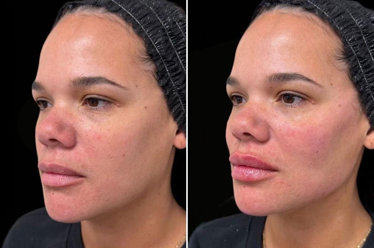 Becker Aesthetics & Plastic Surgery lip filler result — Philadelphia, PA