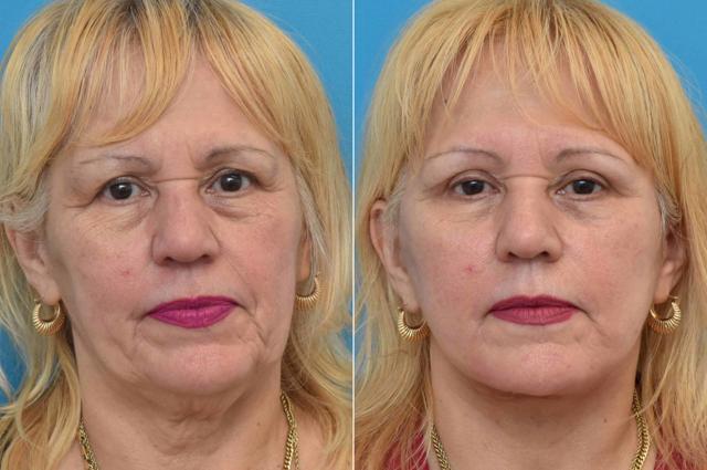 Deep Plane Facelift result at Becker Aesthetics & Plastic Surgery in Philadelphia, PA