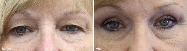 Blepharoplasty result at Becker Aesthetics & Plastic Surgery in Philadelphia, PA
