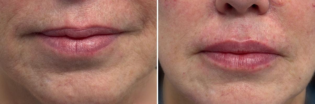 Becker Aesthetics & Plastic Surgery lip filler result — Philadelphia, PA