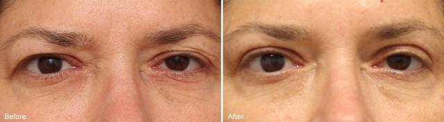 Blepharoplasty result at Becker Aesthetics & Plastic Surgery in Philadelphia, PA