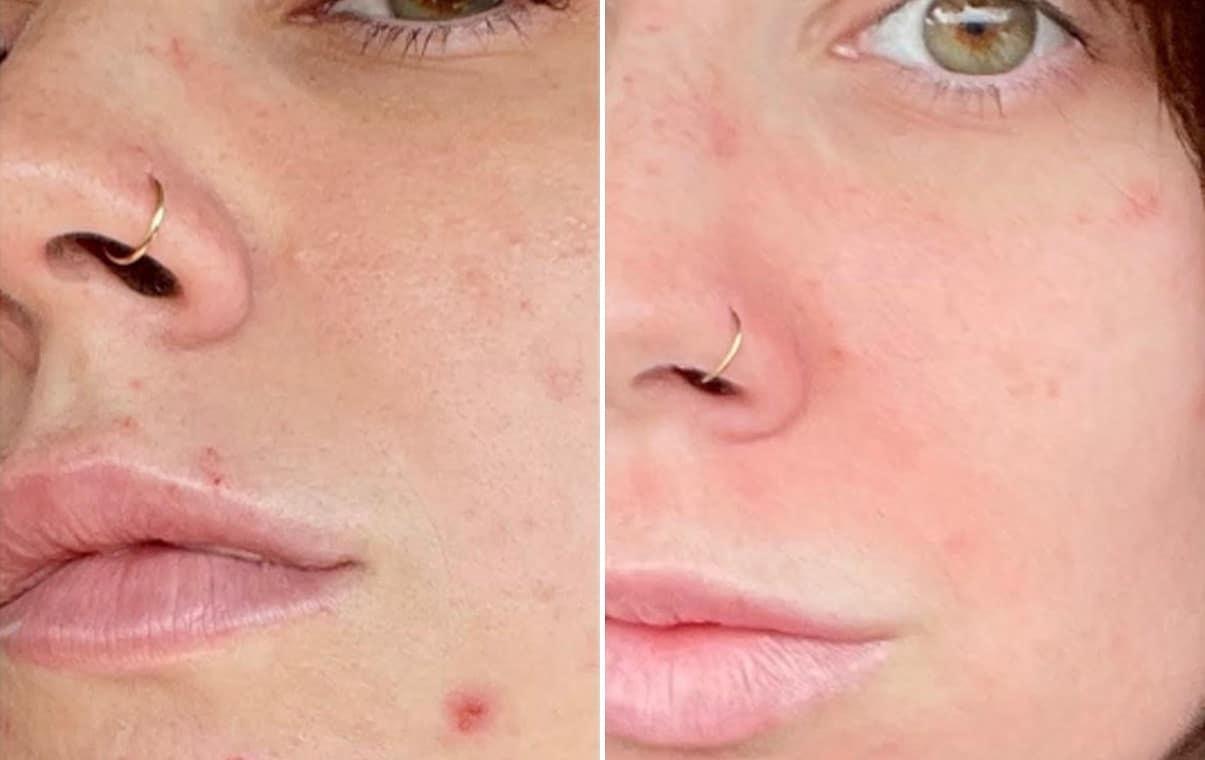 Becker Aesthetics & Plastic Surgery microneedling result — Philadelphia, PA