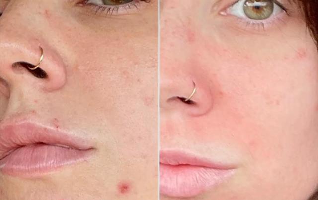 Microneedling result at Becker Aesthetics & Plastic Surgery in Philadelphia, PA