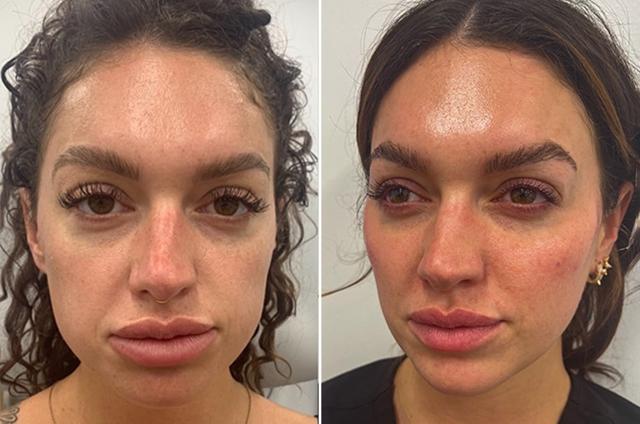 Dermal Fillers result at Becker Aesthetics & Plastic Surgery in Philadelphia, PA
