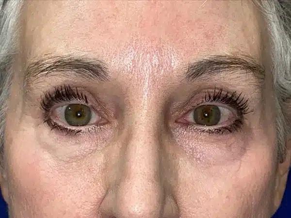 Brow Lift after at Idaho Eyelid & Facial Plastic Surgery in Boise, ID