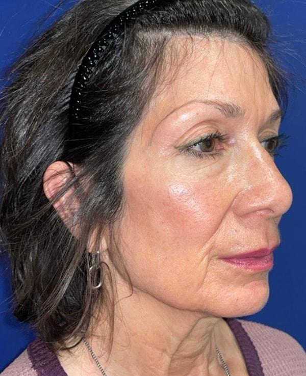 Facelift before at Idaho Eyelid & Facial Plastic Surgery in Boise, ID