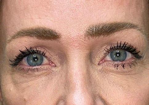 Brow Lift after at Idaho Eyelid & Facial Plastic Surgery in Boise, ID